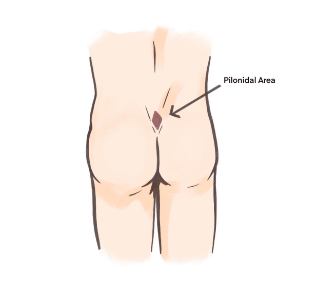 Pilonidal disease commonly occurs near the tailbone