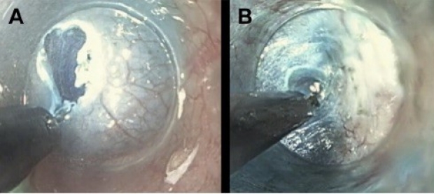 (A) Mucosal incision, (B) Dissection of the submucosal plane exposing circular muscle fibers 